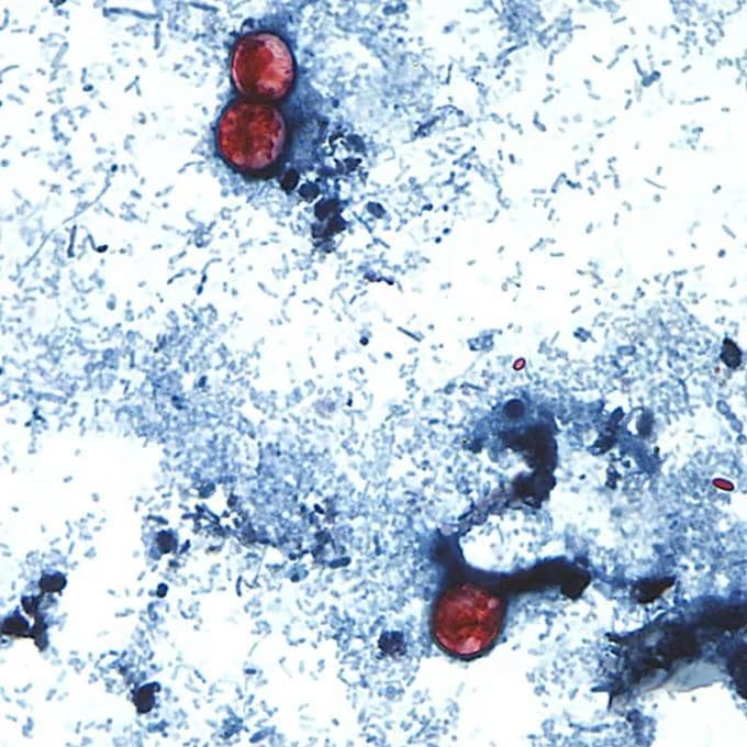 US records first deaths linked to Cyclospora outbreak